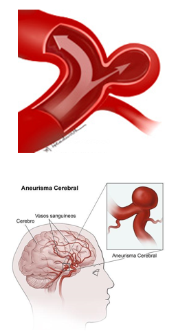 aneurisma-cerebral