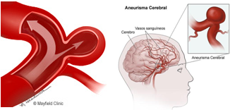 aneurisma-cerebral - Gamma Knife