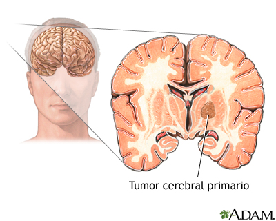 Tumor primario