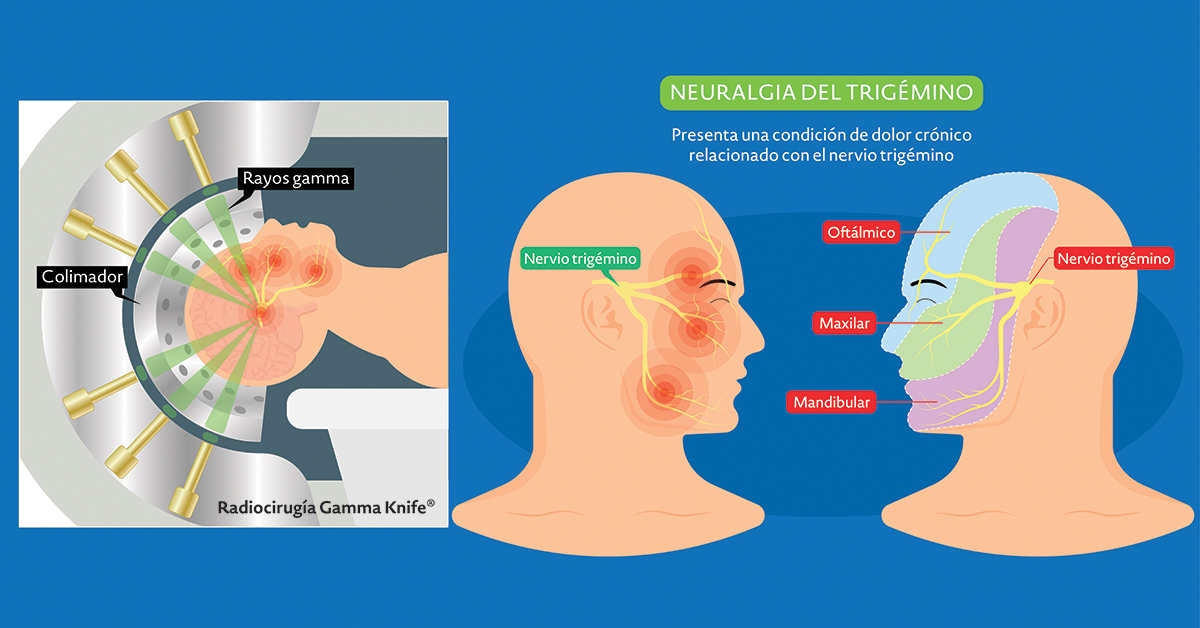 Neuralgia del trigémino: síntomas, causas, diagnóstico y tratamiento